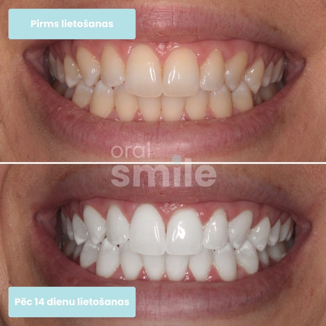 pirms un pēc balināšanas 14 dienu rezultāts lietojot Dabīgo zobu balināšanas pulveri